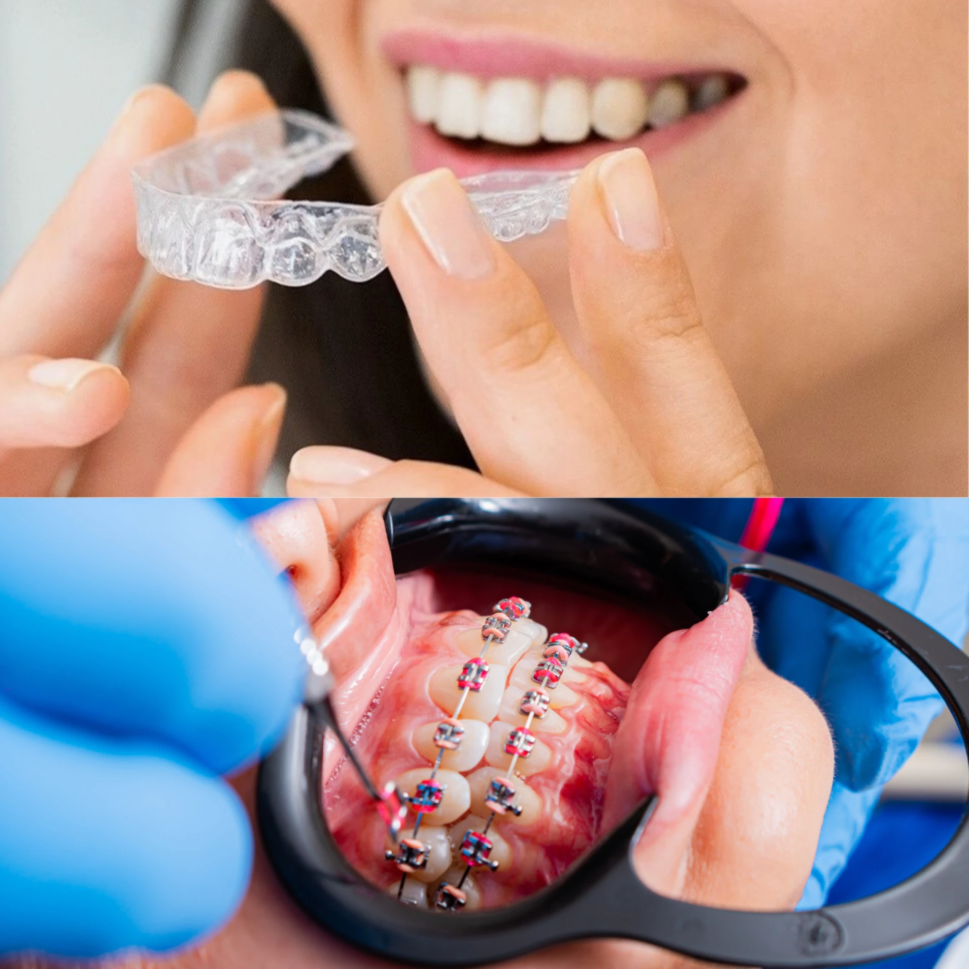 Braces or Invisalign? What UK Patients Need to Know Before Choosing
