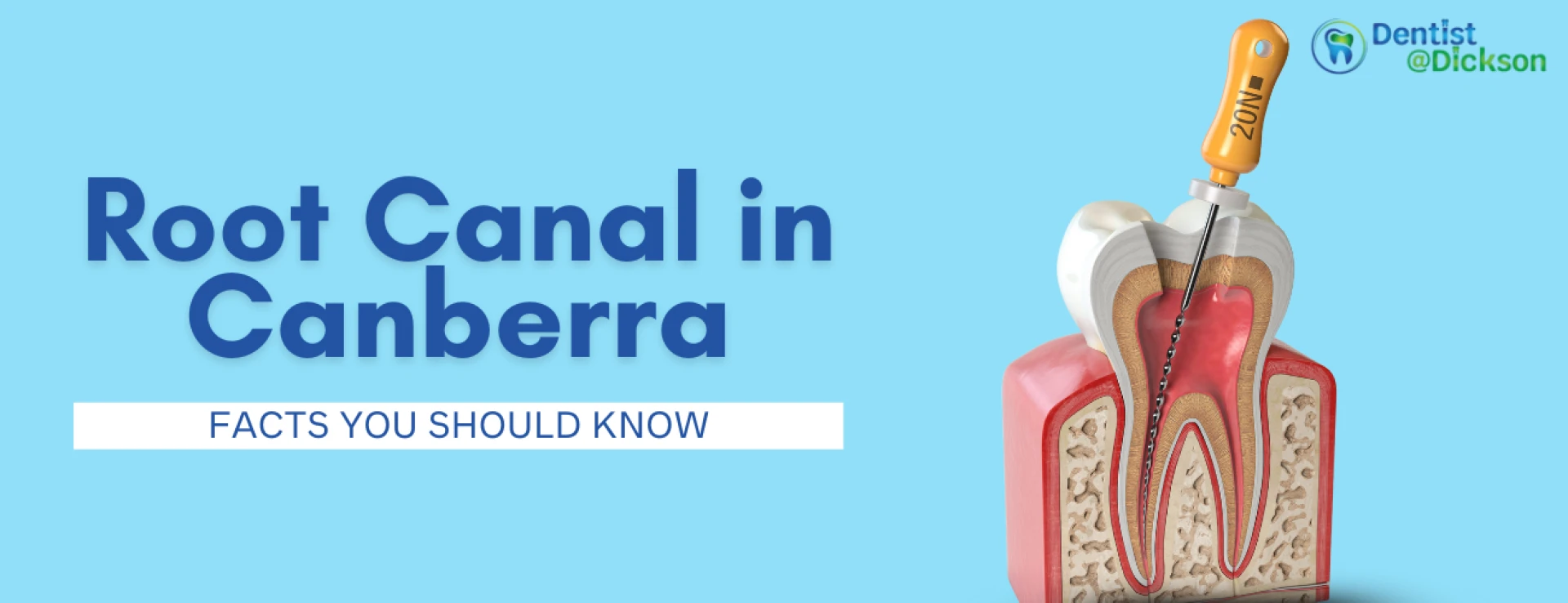 Root Canal in Canberra- Facts You Should Know