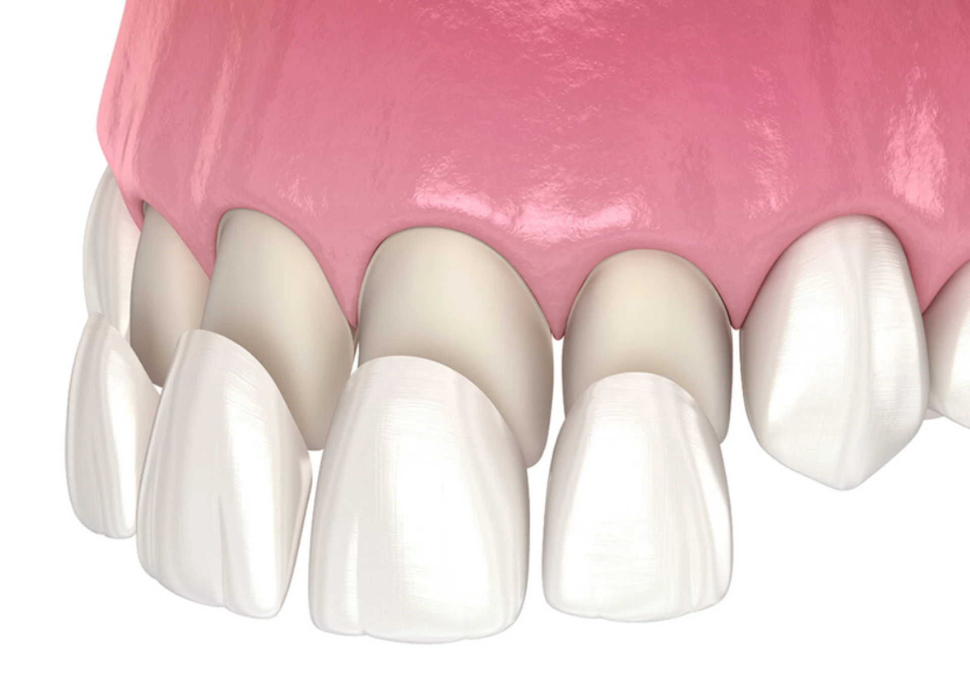 Is it Possible to Use Dental Implants for Full Mouth Restoration? 