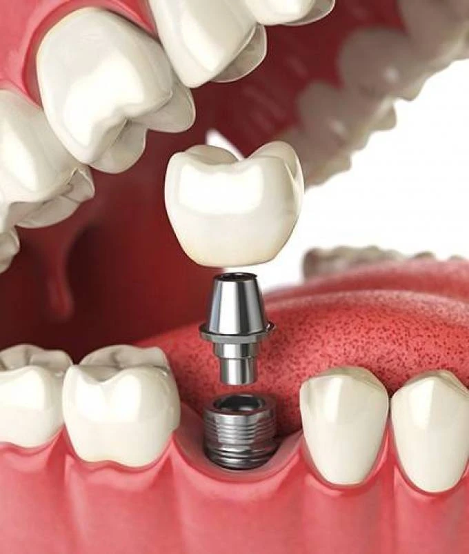 Affordable Dental Solutions: Bridges, Implants, and Endodontic Care