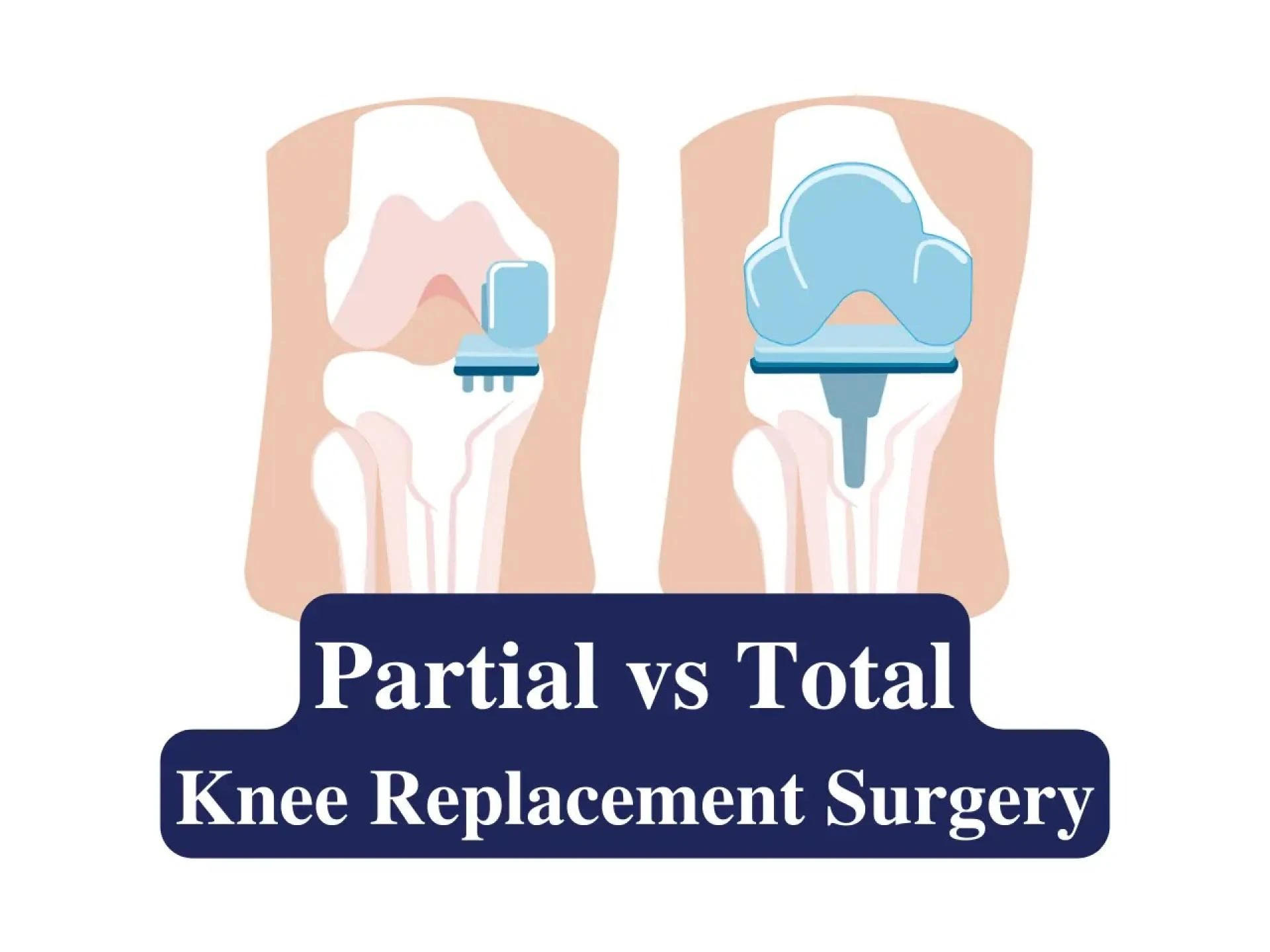Partial vs. Total Knee Replacement: Understanding Your Best Treatment Option