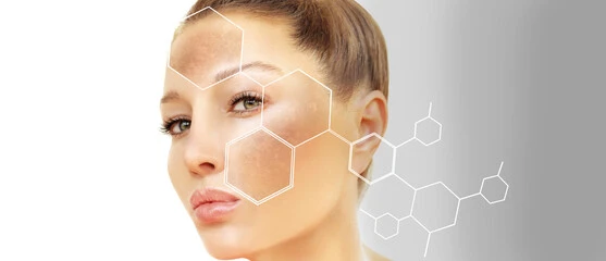 Popular Hyper Pigmentation Treatments in Kerala