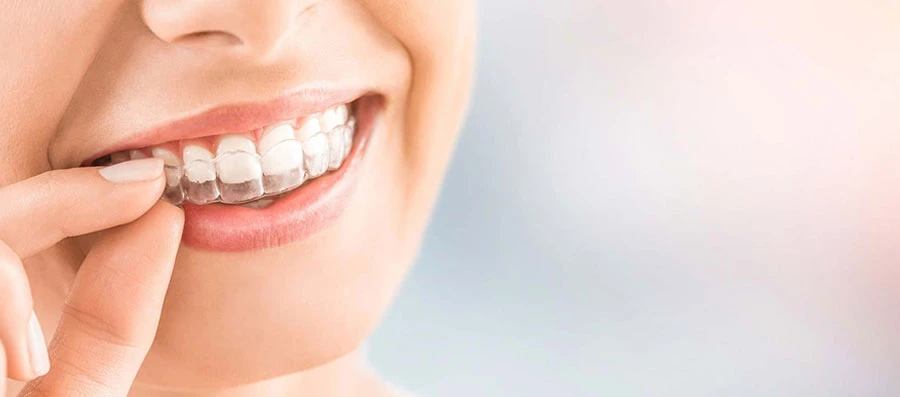 Invisible Braces Treatment in Gurgaon for a Confident Smile