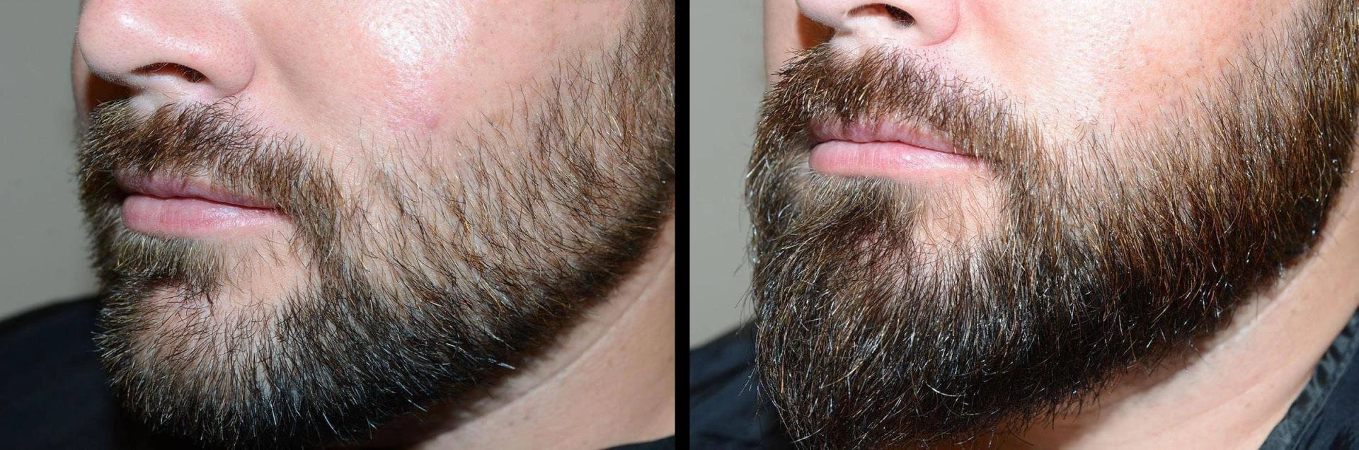 Beard Transplant Explained: Procedure, Pricing & How to Choose the Right Specialist