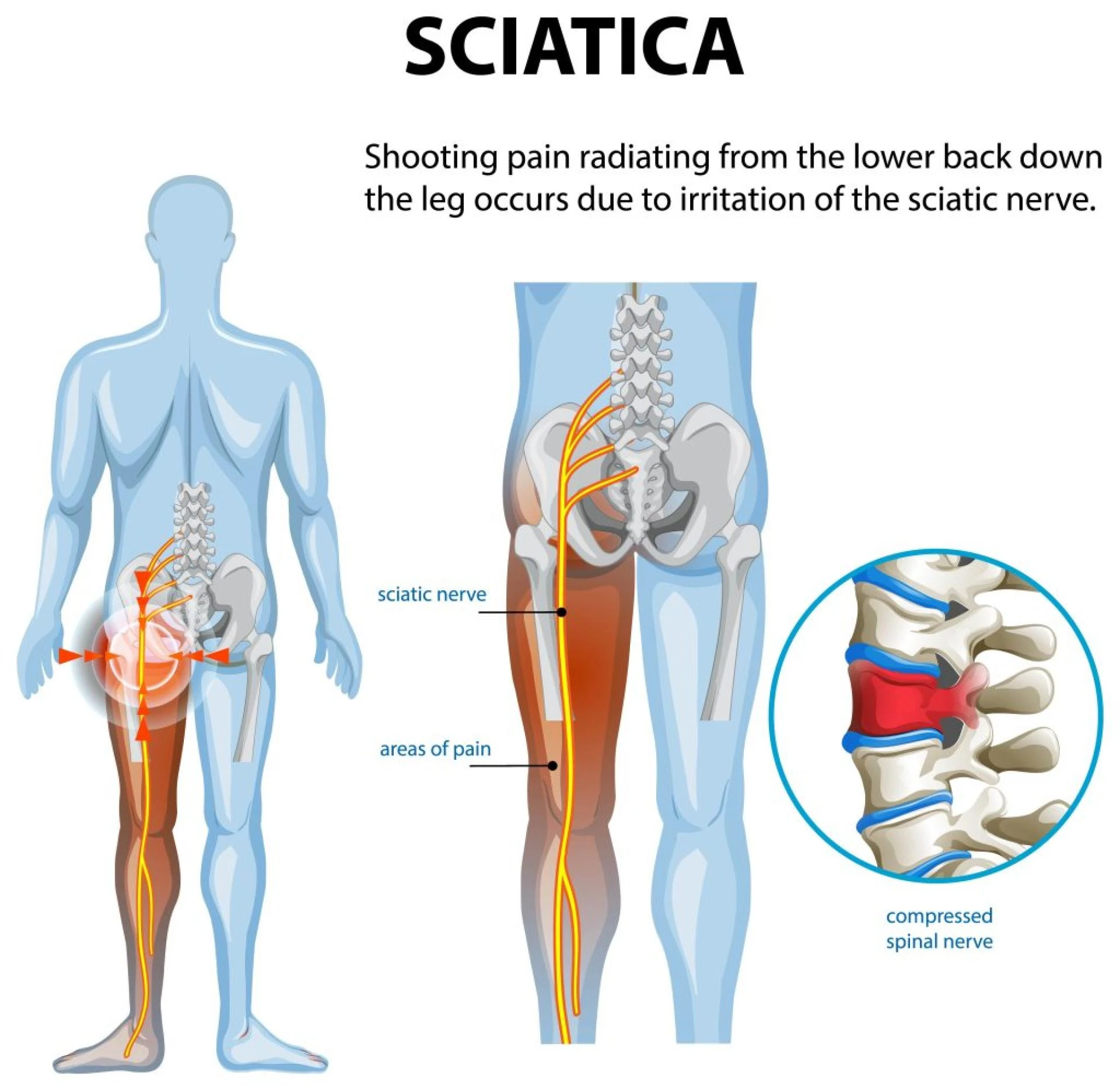 Get Relief Now: Expert Sciatica Treatment in Atlanta and Decatur