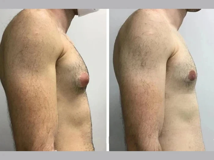 Best Gynecomastia Surgeon in dubai: How They Ensure Successful Male Breast Reduction