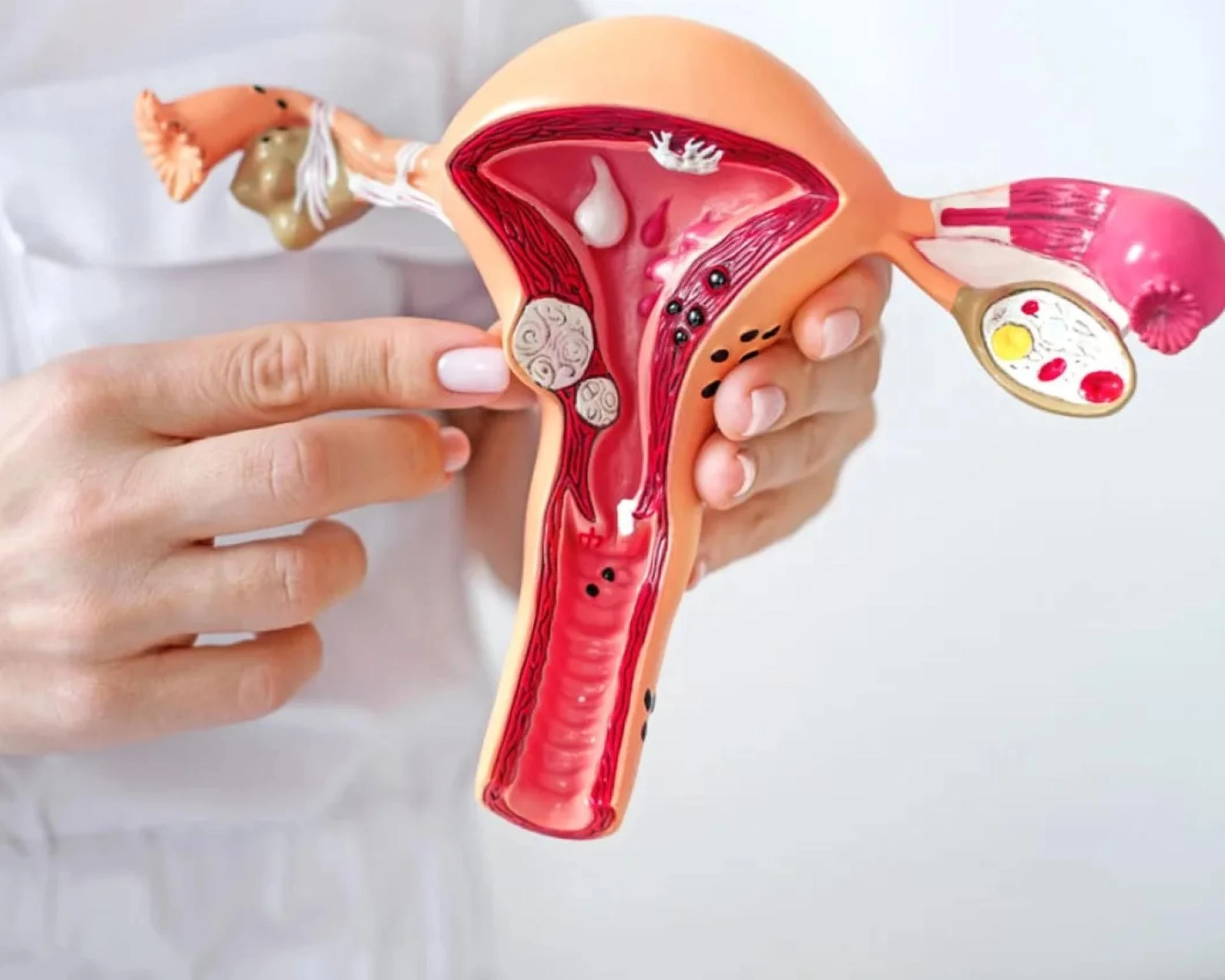 Advanced Adenomyosis Treatment in Ahmedabad – Effective Relief & Expert Caret Title