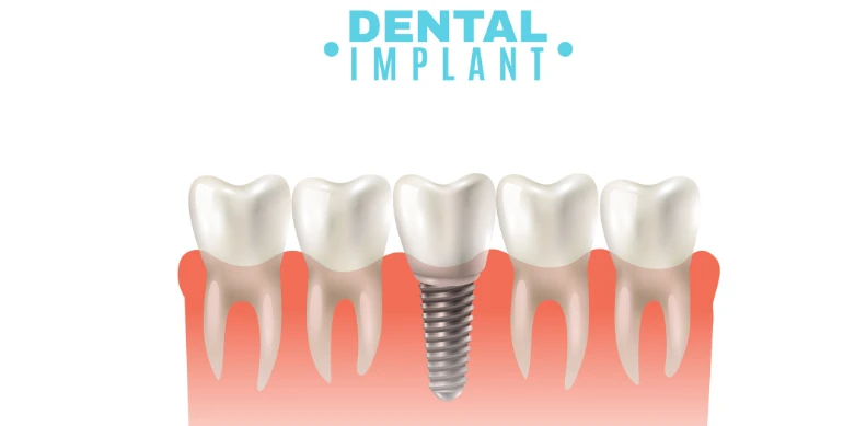 5 Signs You’re a Good Candidate for Dental Implants in Atlanta