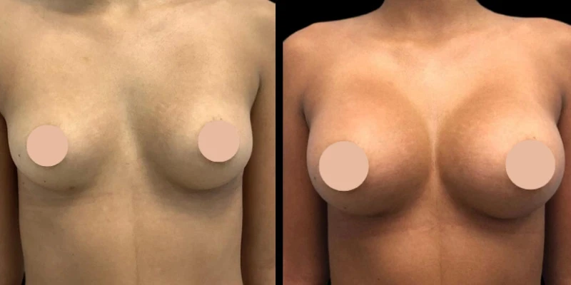 Thinking About Breast Augmentation in Dubai? Read This First