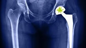 Hip Replacement in Lahore – Advanced Solutions for a Pain-Free Life