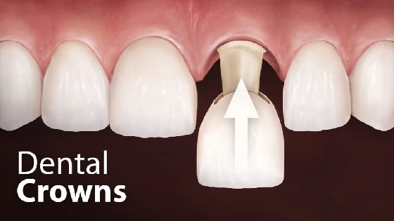 A Practical Guide to Crown Dental Treatment