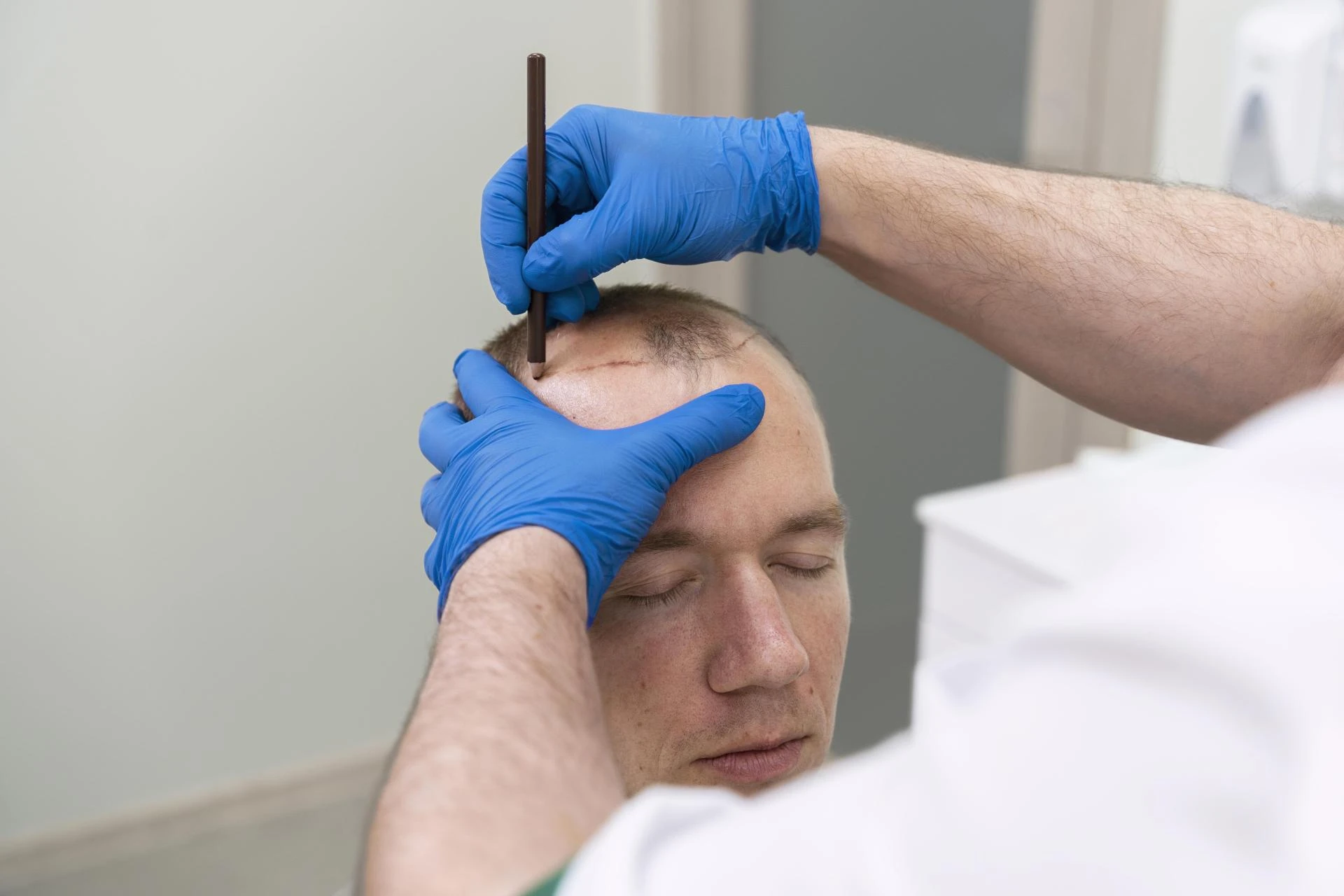 Common Hair Transplant Myths Debunked 
