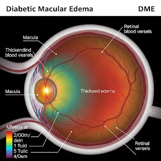 DME in Focus: Tracking Clinical Breakthroughs and Global Market Expansion