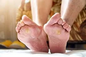 Effective Plantar Warts Treatment & Advanced Foot Care
