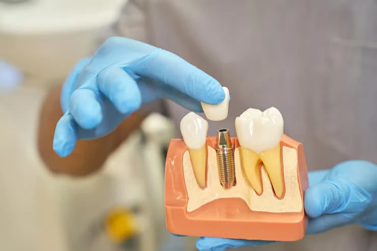 Everything You Need to Know About Getting Dental Implants in Medford