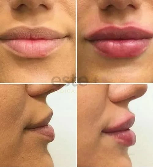 Lip Enhancement in Edinburgh: Subtle, Stunning, and Safe
