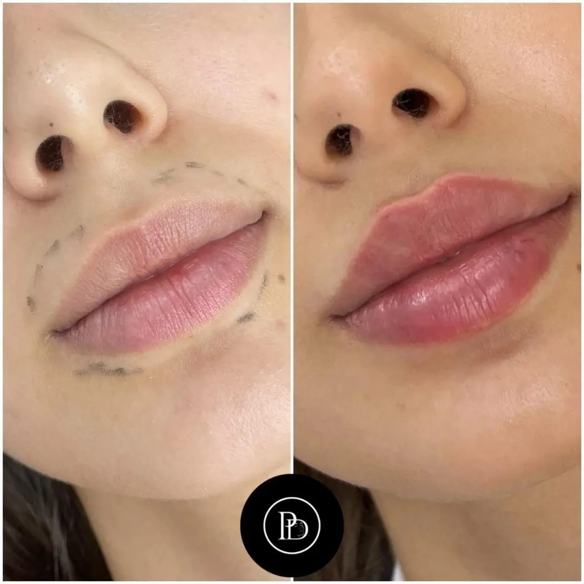 How Dermal Fillers Treatment in Dubai Has Evolved Over the Years