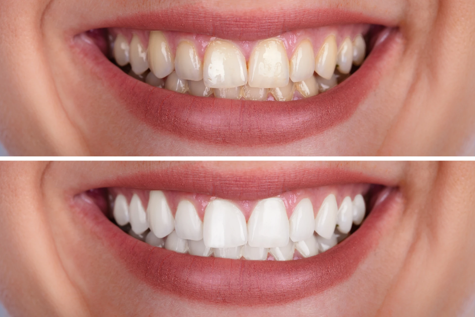 Common Mistakes To Avoid During Teeth Whitening Treatments