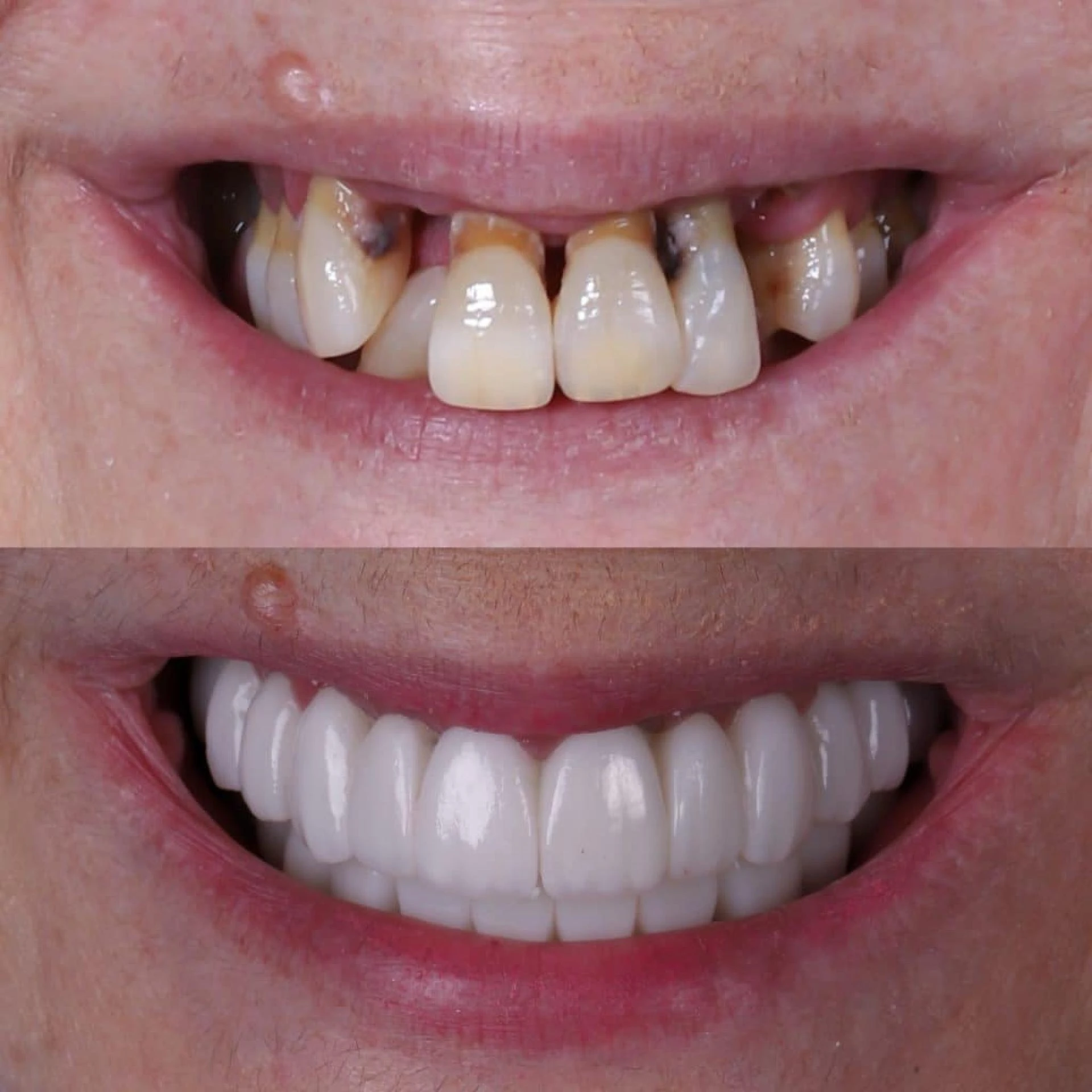 Beneficios y Consideraciones de los implantes dentales en Albania