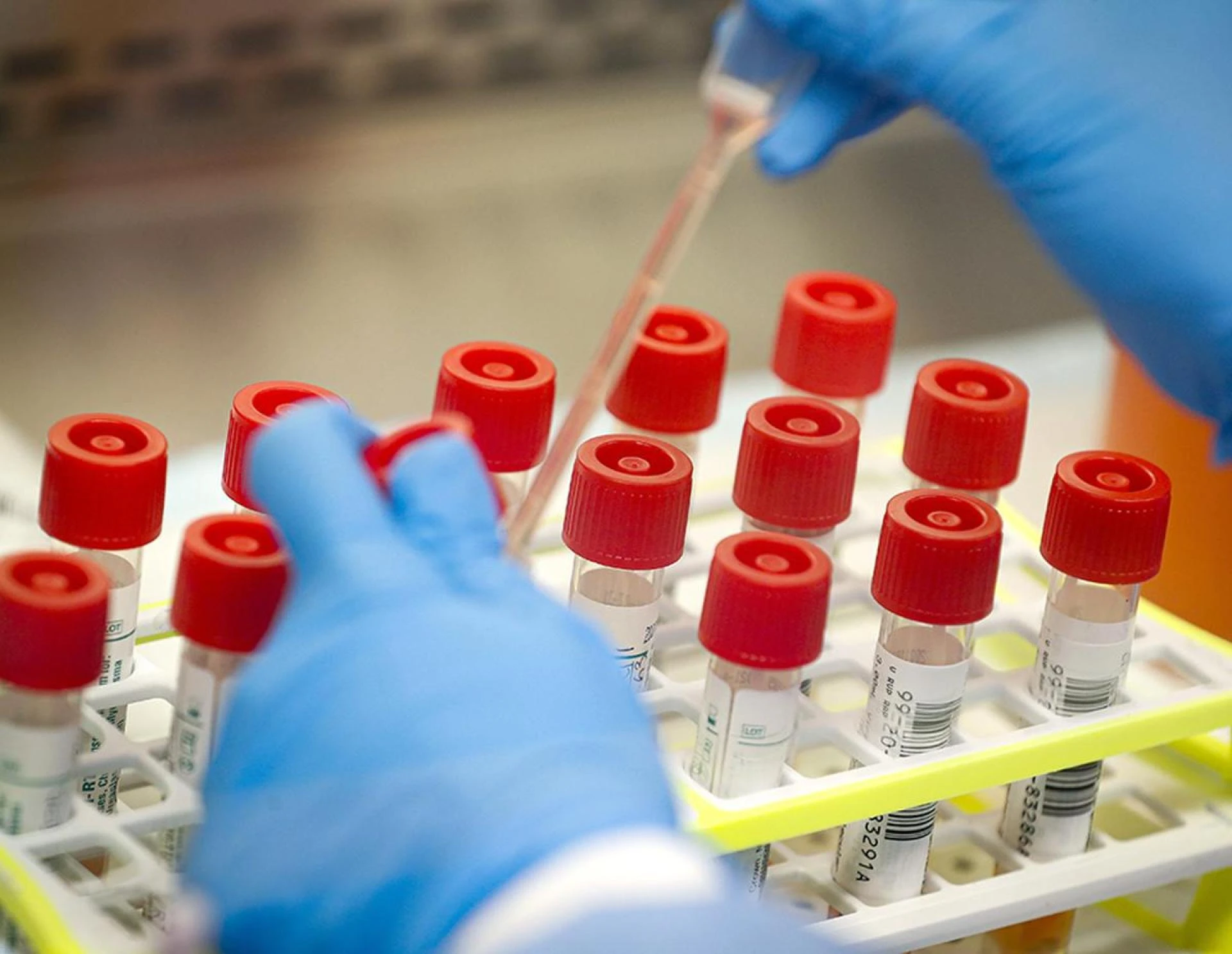 Importance of Choosing the Right Hospital for Lab Tests in East Delhi