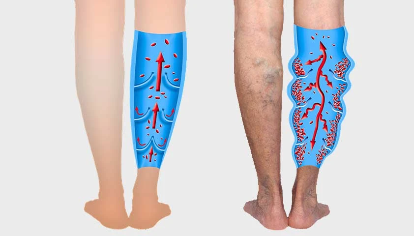 Regain Confidence and Comfort: A Complete Guide to Varicose Vein Surgery in Kyiv