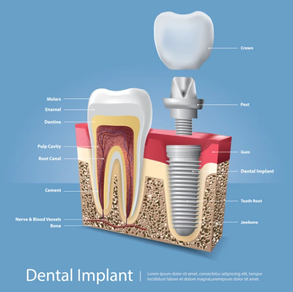 Choosing the Right Clinic for Dental Implants in Chandigarh: What to Consider
