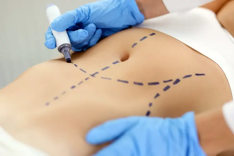 Understanding the Costs of a Tummy Tuck Procedure in Sarasota