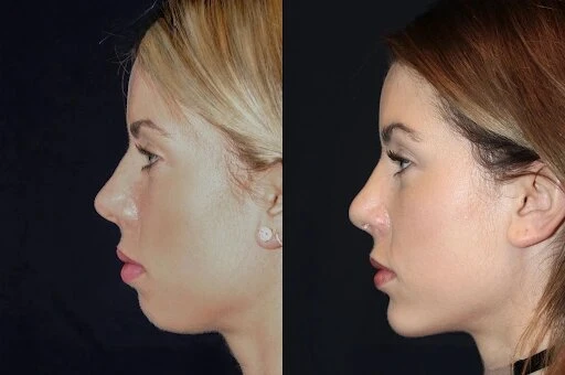 Best Aesthetic Clinics in dubai for Chin Fillers: Safe and Effective Treatments