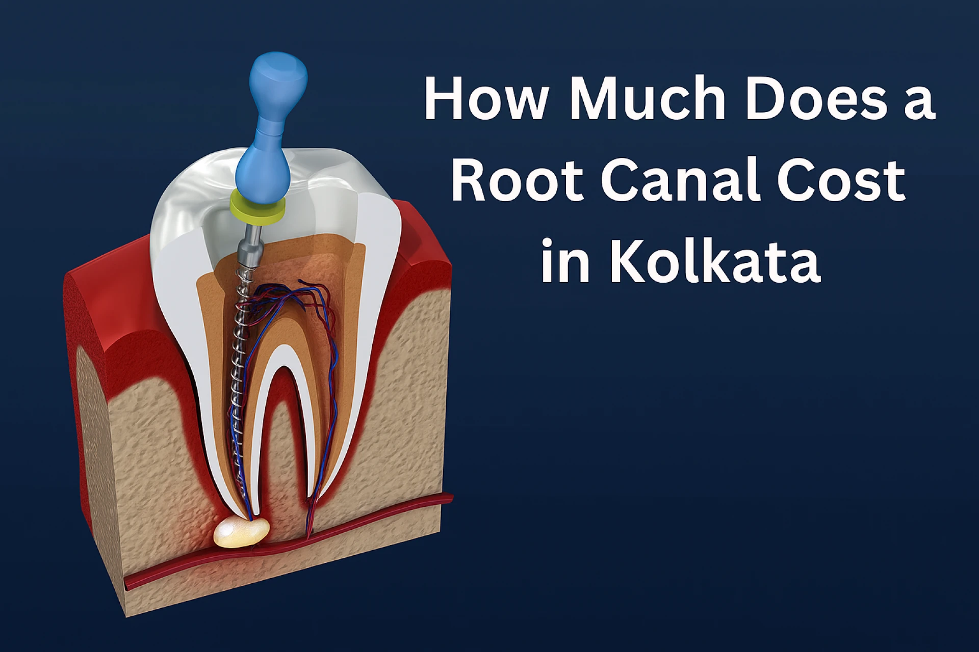 How Much Does a Root Canal Cost in Kolkata? A Patient’s Guide