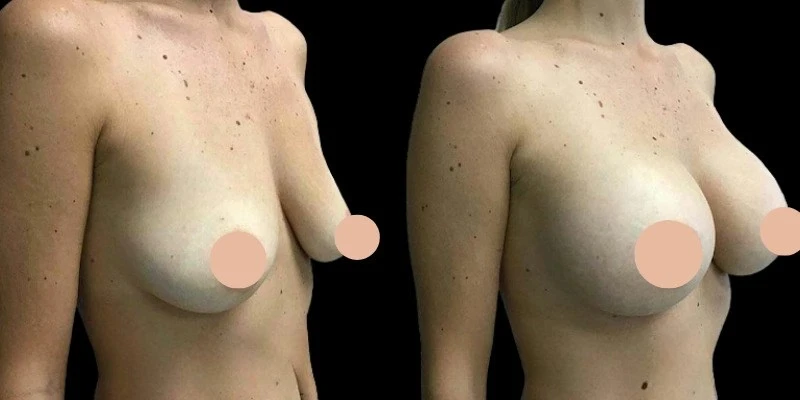 The Role of Technology in Breast Augmentation in Dubai: Advancements and Techniques