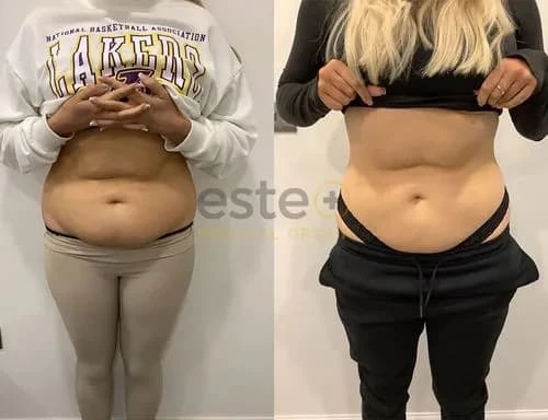 Freeze Fat Away: Non-Invasive Fat Reduction in Birmingham