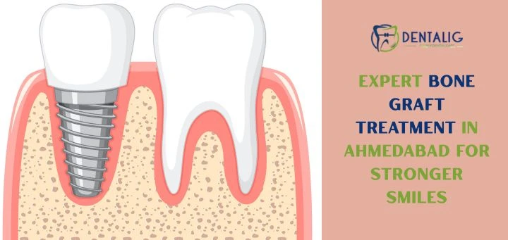 Expert Bone Graft Treatment in Ahmedabad for Stronger Smiles