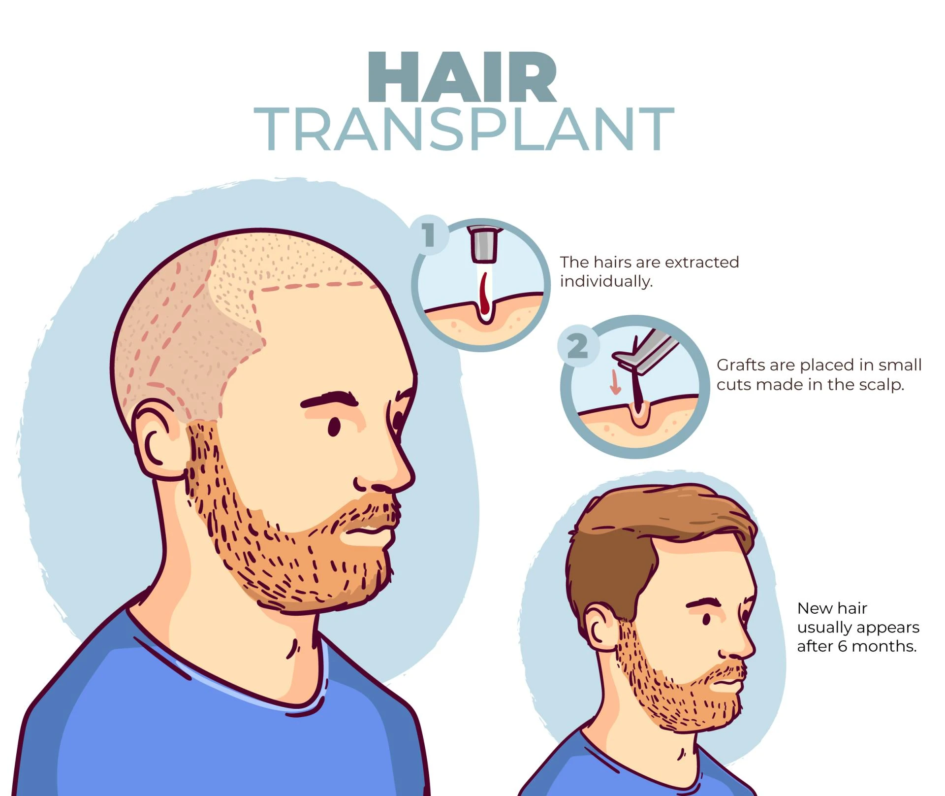 What to Expect After Hair Transplant?