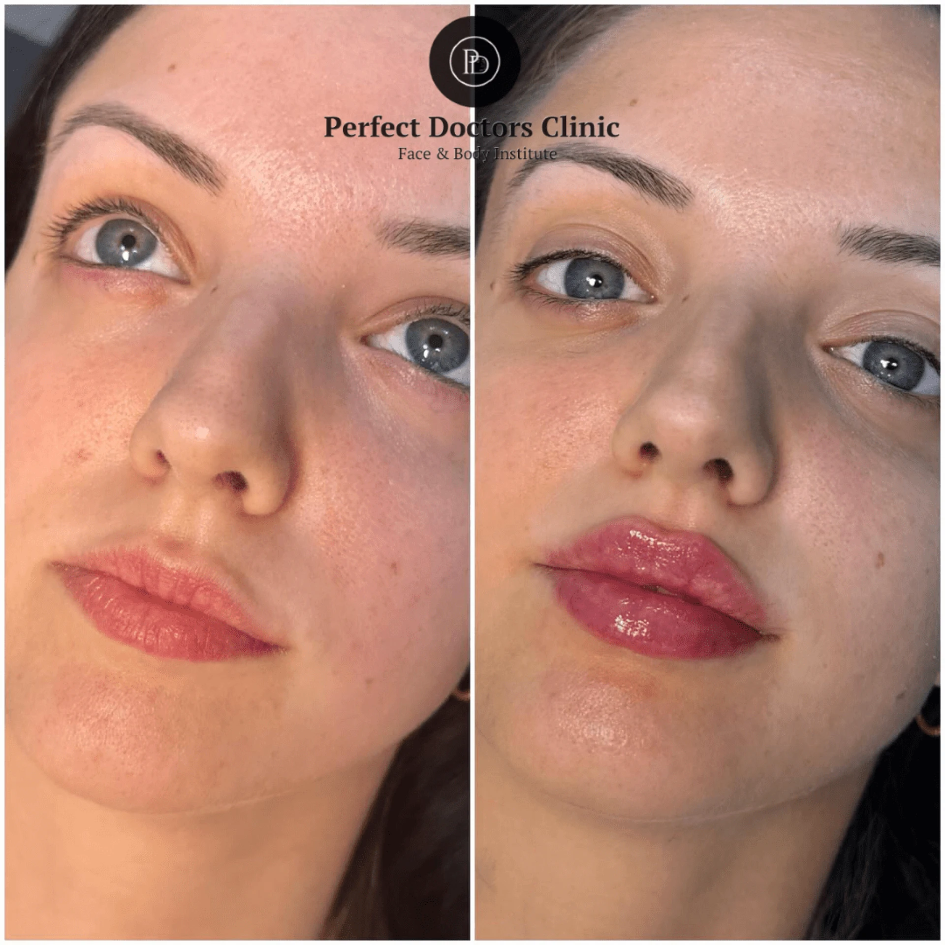 Juvederm and Hyperpigmentation: The Best Doctors in Dubai Weigh In