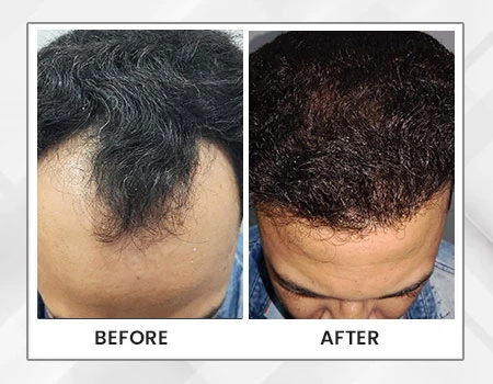 Reversing Hair Fall: Kolkata’s Modern Approach to a Timeless Concern
