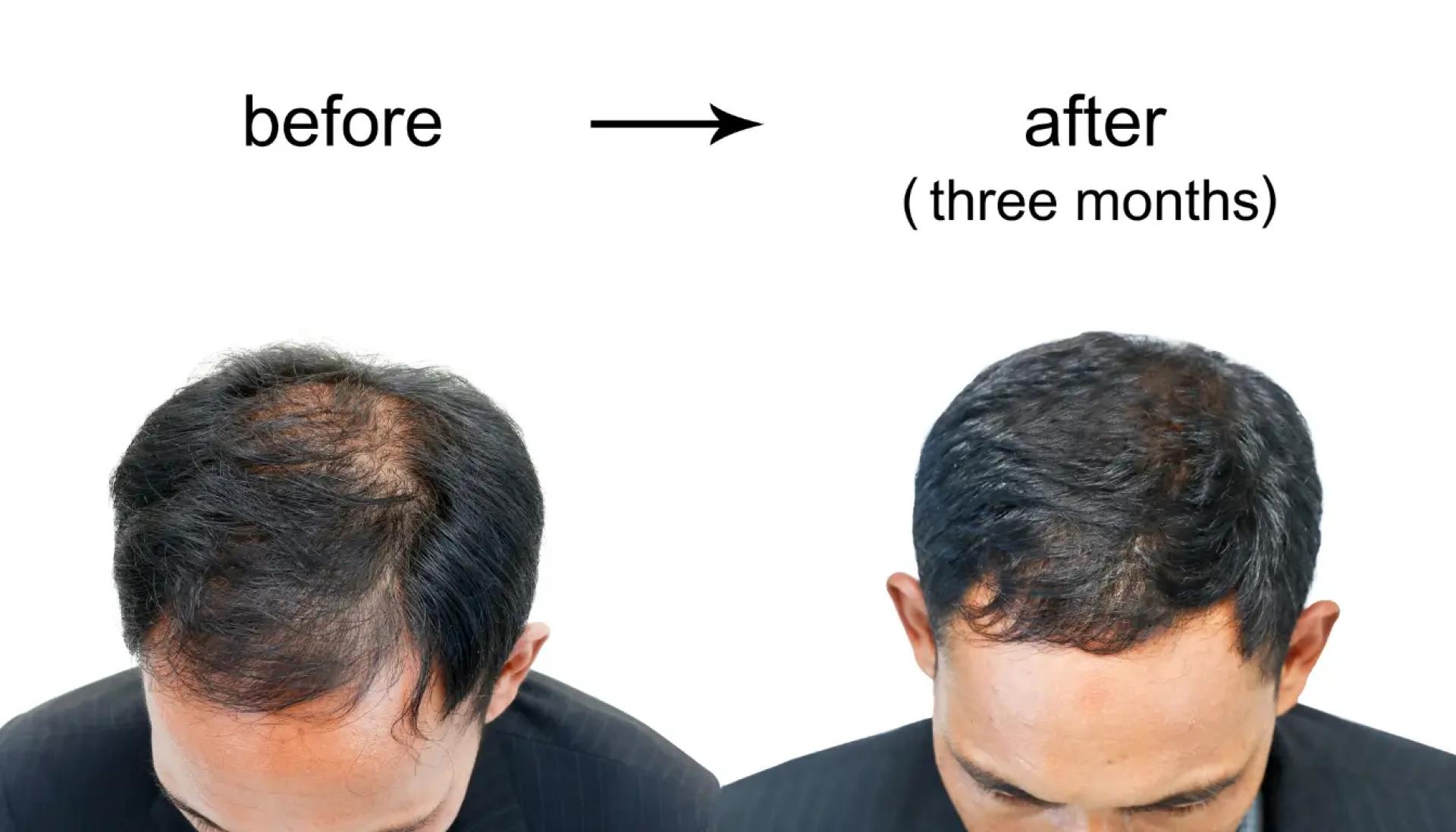 Is Poland Safe for Hair Transplant Procedures?