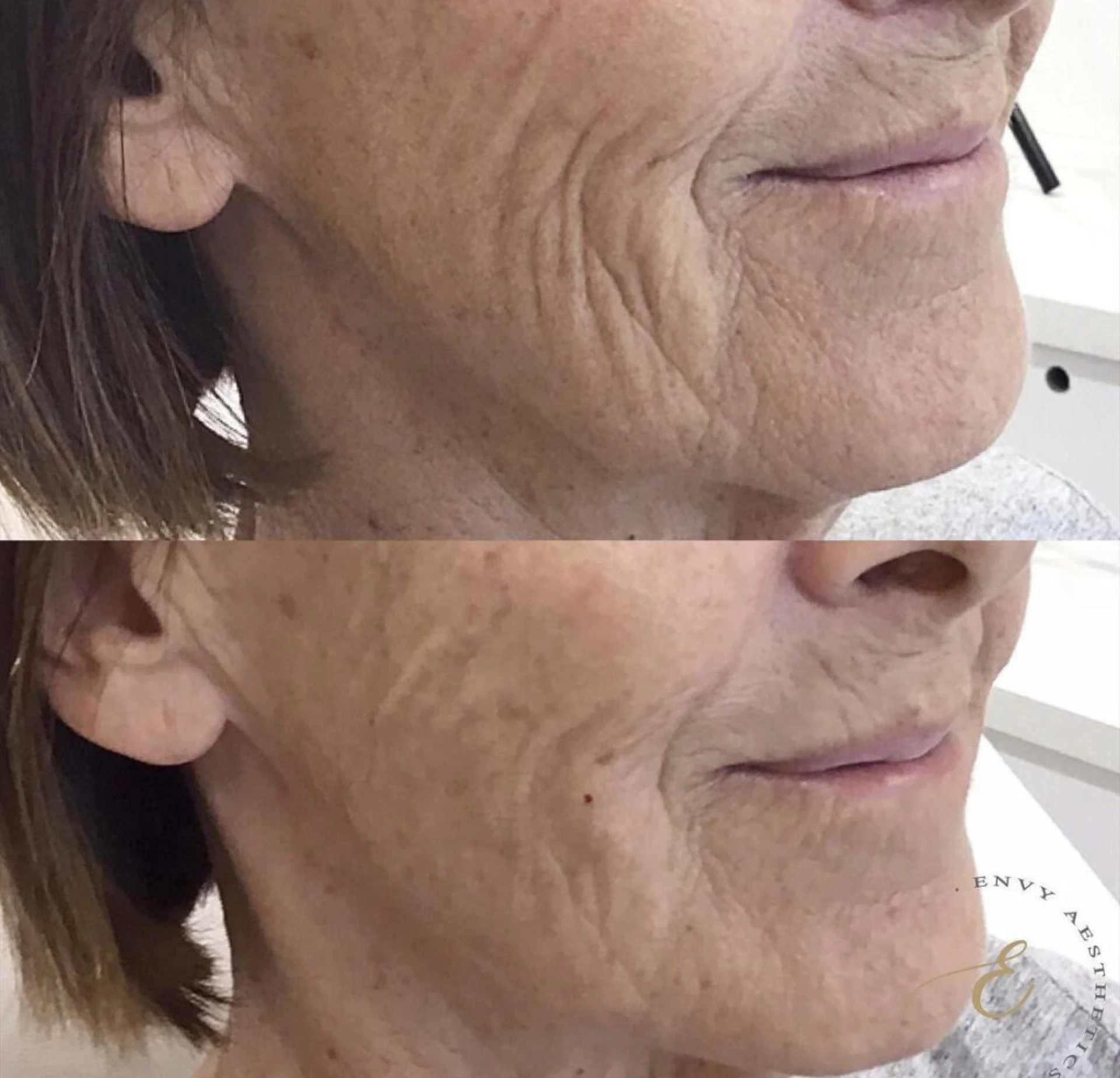 Are Skin Boosters Worth It? Benefits and Key Differences Explained