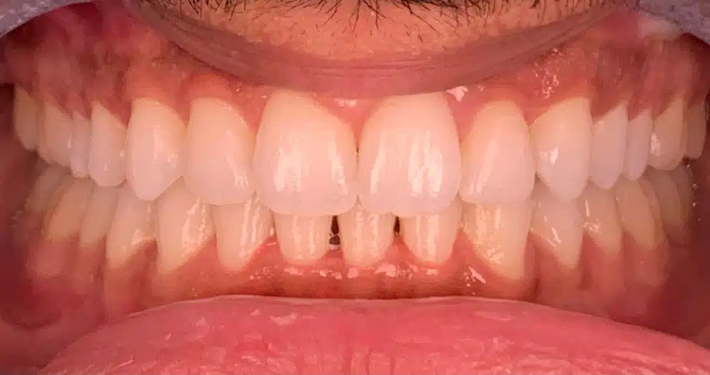 How Long Do Dental Implants Last?