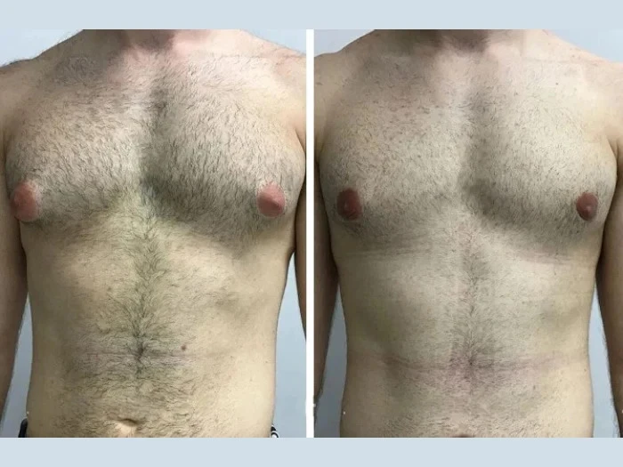 Key Factors to Consider When Choosing the Best Gynecomastia Surgeon in dubai