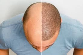 The Truth Behind Beard Transplant Before and After Results