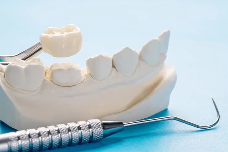 Dental Crowns Near Me with Same-Day Service