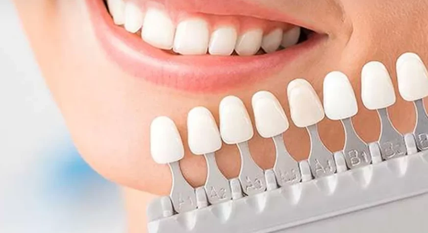 Dental Veneers Abu Dhabi | Best Dental Veneers Treatment UAE