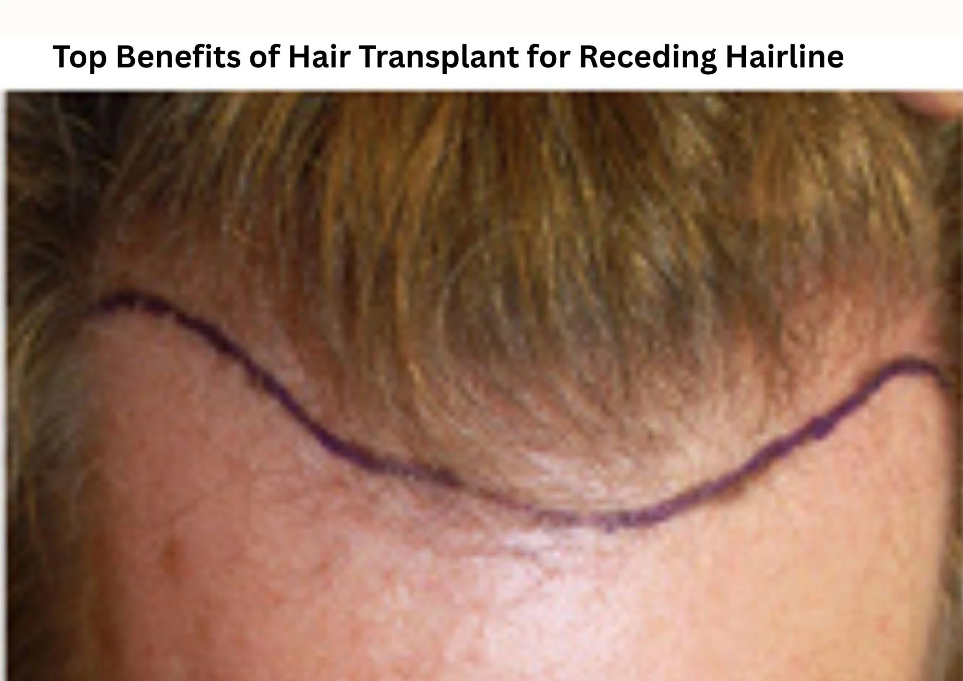 Top Benefits of Hair Transplant for Receding Hairline