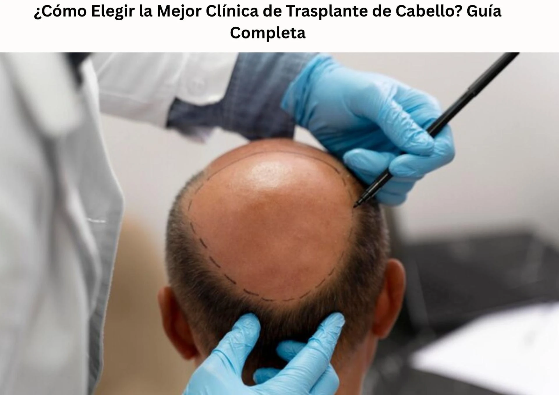 ¿Cómo Elegir la Mejor Clínica de Trasplante de Cabello? Guía Completa