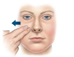 How to Treat Nasal Valve Collapse: A Comprehensive Guide