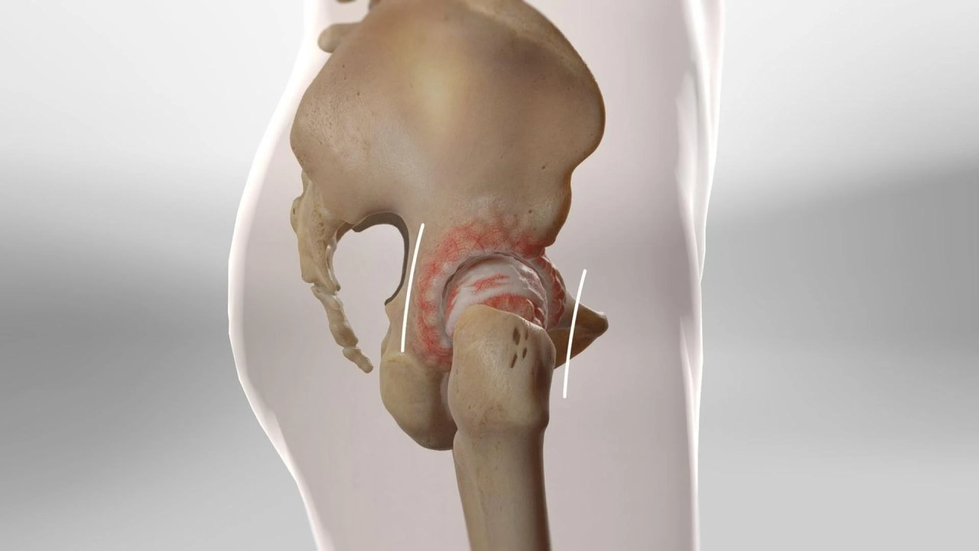 Complete Guide to Recovery After Total Hip Replacement Surgery in Delhi