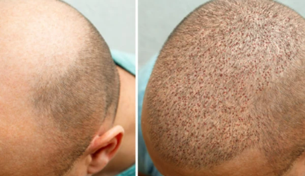 Best Clinic for Hair Transplant in Islamabad