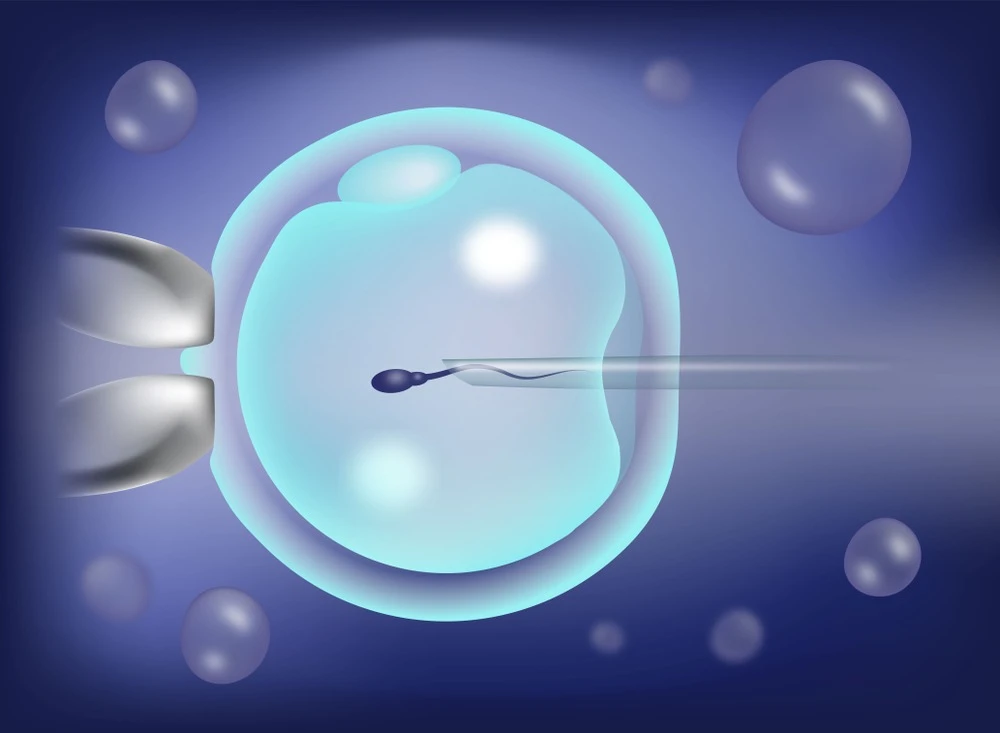 IMSI Treatment: A Breakthrough in Male Infertility Solutions