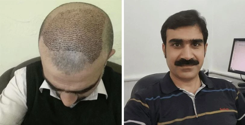 Unlocking Hair Health: The Rise of Non-Surgical Hair Treatments in Islamabad