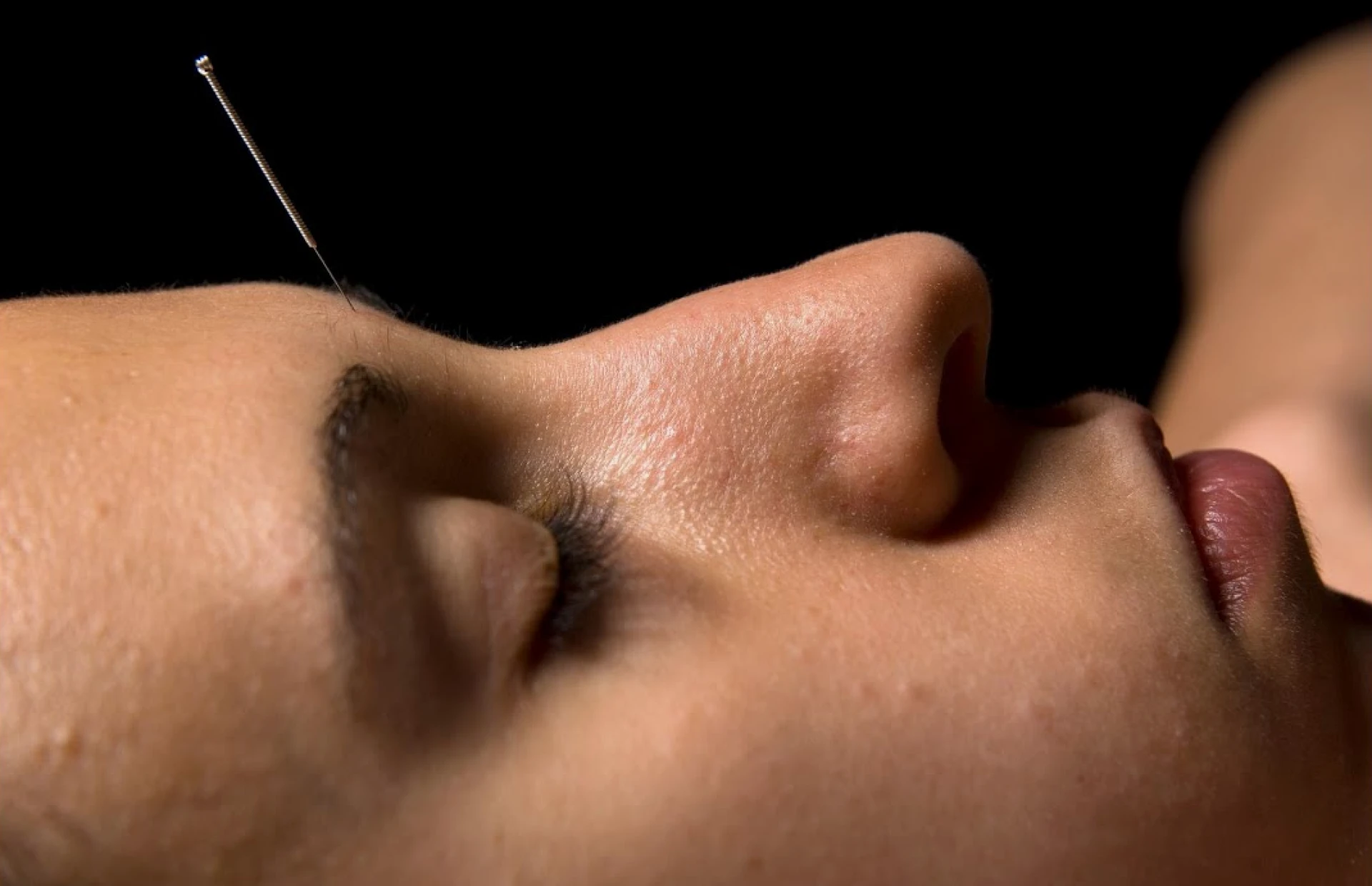Why Your Sleepless Nights Might Be a Sign You Need Acupuncture